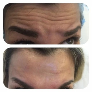 Ботокс для лица до и после. После ботокса можно в спортзал. Ботокс до и после. Ботокс в щеки. Ботокс для лица до и после.