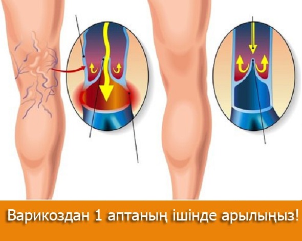 ⚡ Әрбір үшінші әйел варикоздың зардабын шегеді. Ең арзан жән